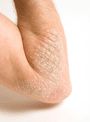 psoriasis_xs.png
