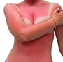 sunburn_xs2.png